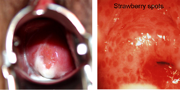 Herpes Genital - Intravaginal