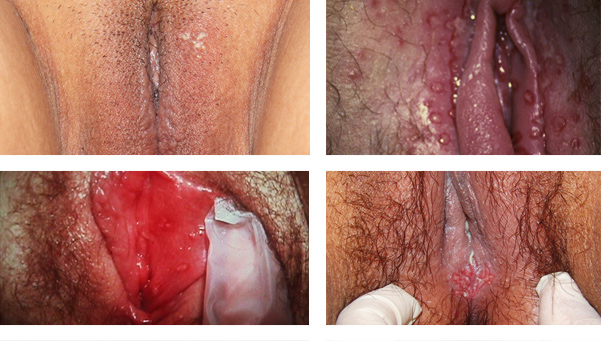 Herpes Genital en la Vagina